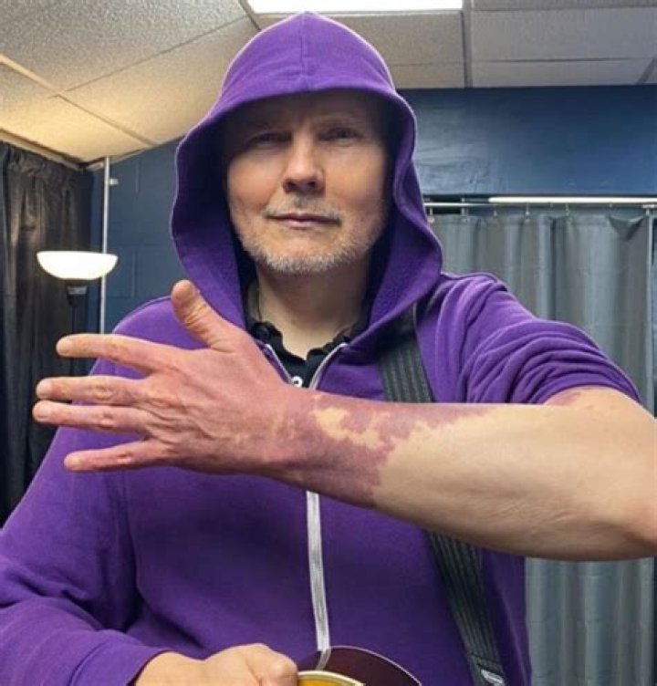 Billy Corgan Forehead | Does He Have A Birthmark On It