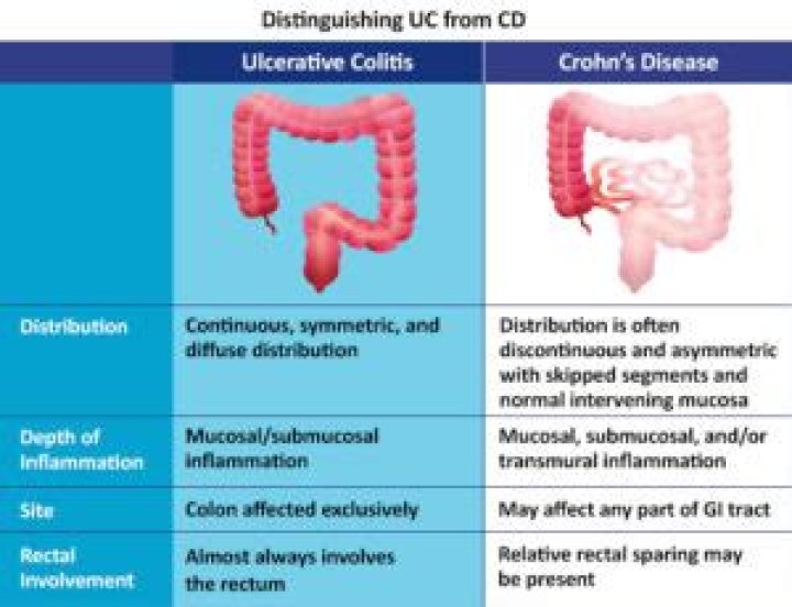 Chantelle Leonardo Illness | IBD UC Diagnosis And Surgery
