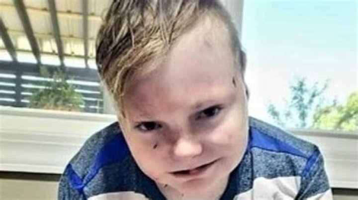 Death Information Of Charlie Knuth, Darboy Boy Lost Battle With Rare Skin Disease