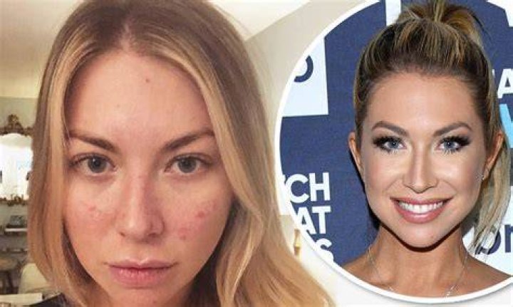 Stassi Schroeder | Plastic Surgery And Breast Reduction Surgery
